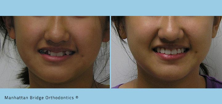 extraction braces teeth before vs non orthodontics treatment patient bridge manhattan