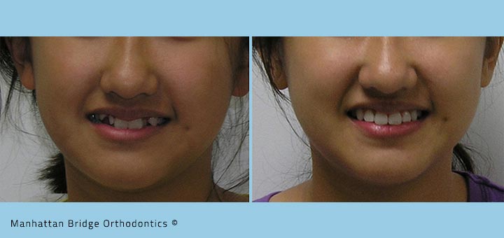 Patient A (Non-Extraction) – Before and After