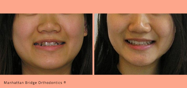 Patient B (4 Bicuspid Extractions) – Before and After