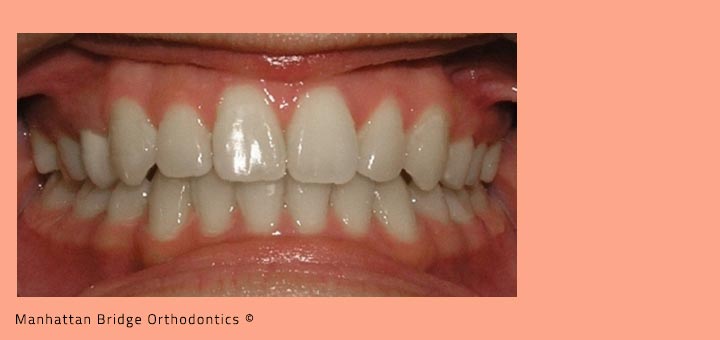 Patient B (4 Bicuspid Extractions) – After