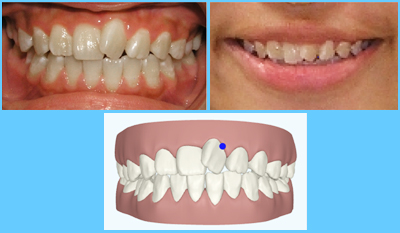 Tooth size discrepencies before