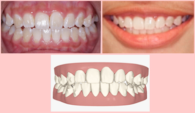 Teeth Size Chart