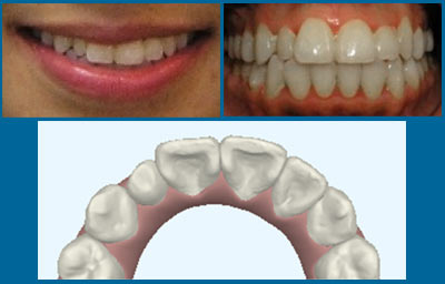 Denture Teeth Size Chart